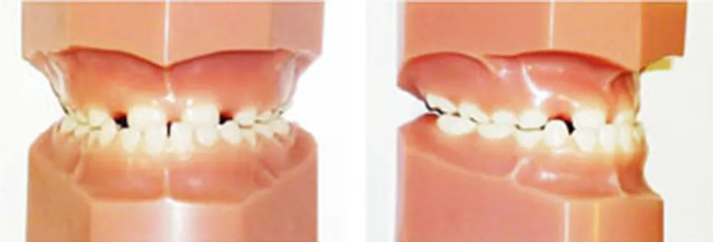 受け口(下顎前突・反対咬合)