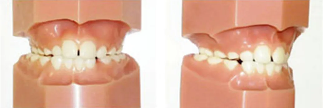 交叉咬合(こうさこうごう)