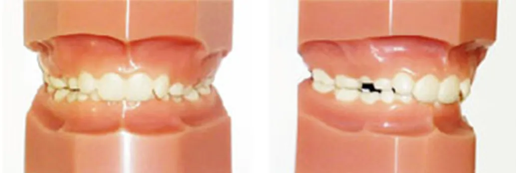 過蓋咬合(かがいこうごう)