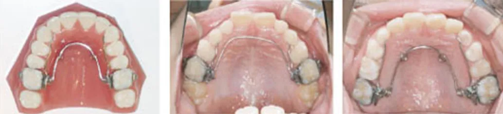 上顎の拡大装置