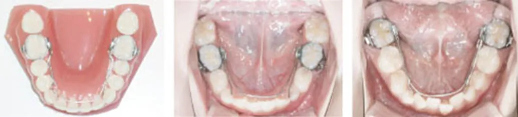 緩徐拡大装置(ミア/クワッドヘリックス/Wアーチ)