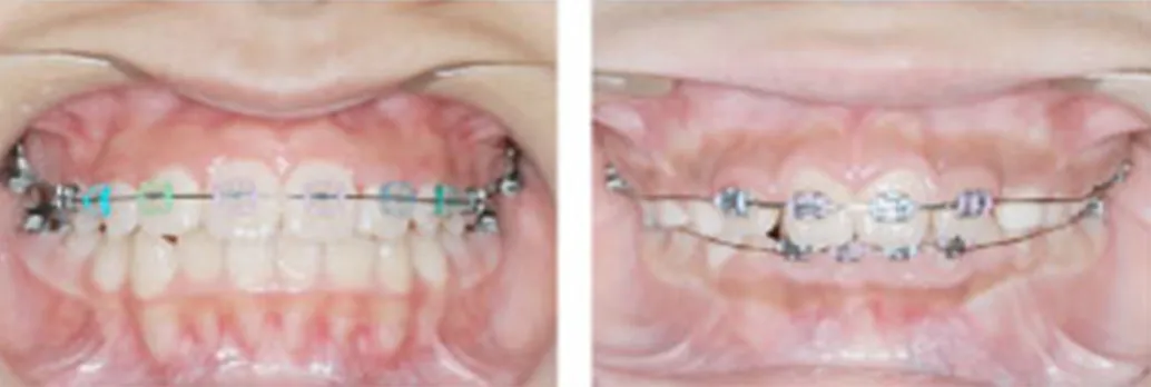 前歯を並べる装置