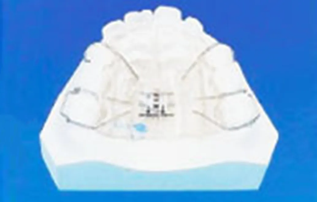 上顎と下顎の拡大装置