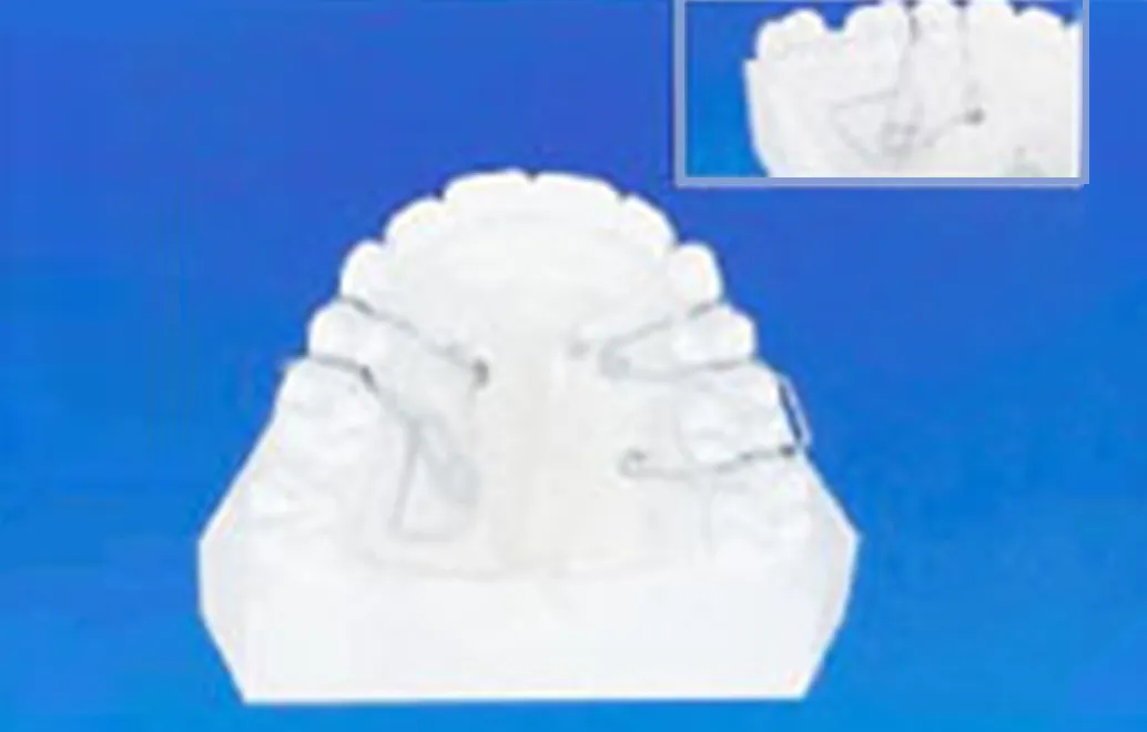 大臼歯を後ろに移動させる装置